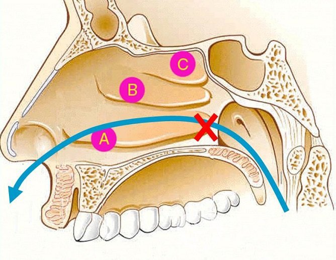 При воспалении слизистой оболочки носа отмечается нарушение носового дыхания