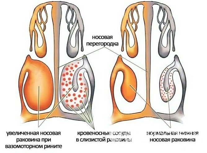 Для назначения адекватного лечения важно определить этиологию развития насморка