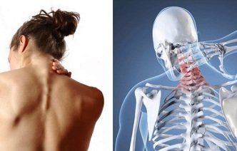 Лечение шейно-грудного остеохондроза – эффективно и без врачей