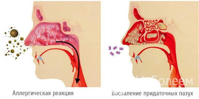 Синусит может развиваться вследствие аллергической реакции при присоединении бактериальной инфекции