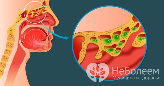 Полипы и аденоиды являются предрасполагающими факторами развития синусита