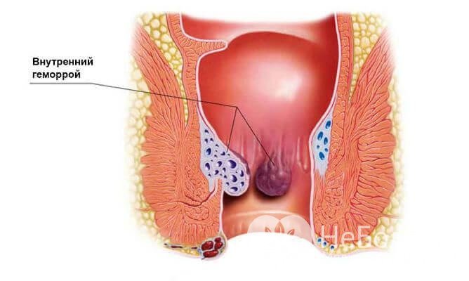 Внутренний геморрой часто ничем не проявляет себя на ранней стадии