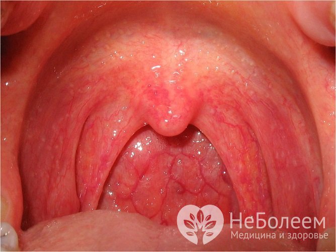 Для болезни характерна гиперемия и отек слизистых тканей носоглотки