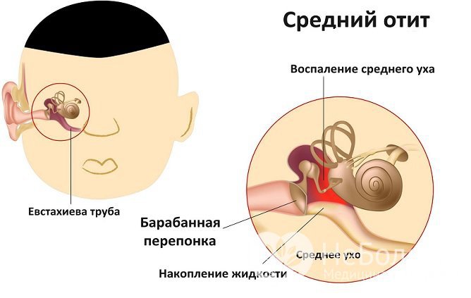 Одно из возможных осложнений ринита задней стенки при отсутствии адекватного лечения – отит