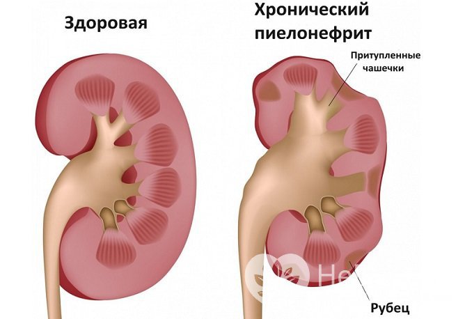 Одна из распространенных причин повышения лейкоцитов в моче – хронический пиелонефрит