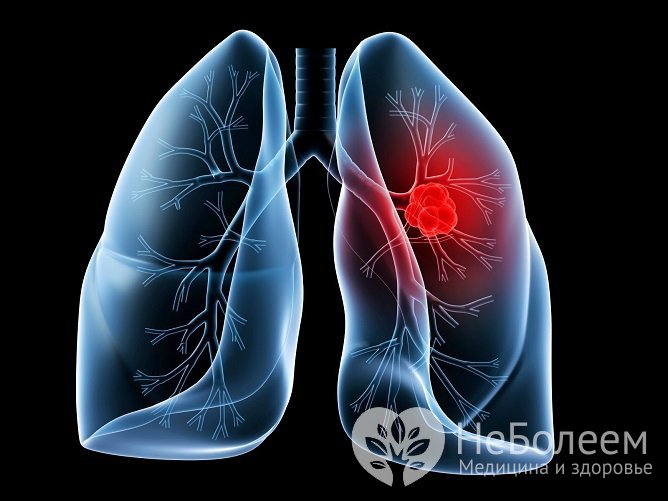 Развитие левостороннего воспаления легких встречается реже правосторонней пневмонии