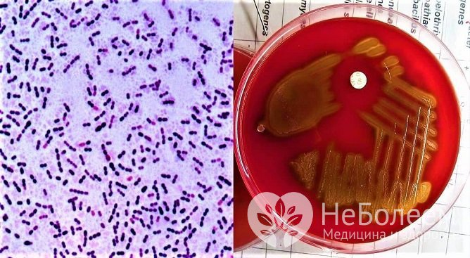 Для Streptococcus pneumoniae характерно развитие типичного синдрома пневмонии