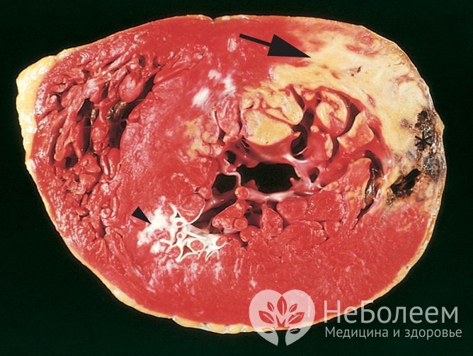 Инфаркт миокарда угрожает жизни пациента, и потому требует немедленной врачебной помощи