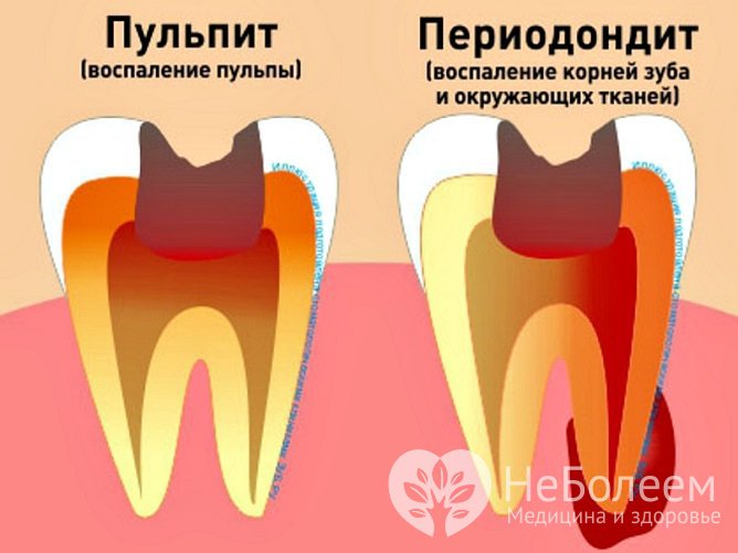 Причиной возникновения гайморита могут быть заболевания зубов верхней челюсти, включая периодонтит и периостит