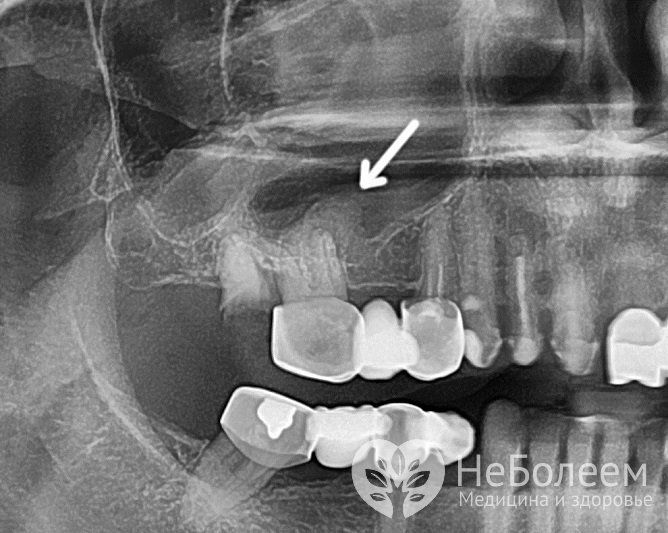 Для диагностики болезни назначается рентгенологическое исследование