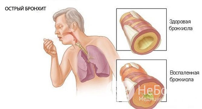 Острая форма бронхита сопровождается сильным кашлем из-за воспалительного экссудата в бронхах