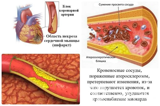 Инфаркт возникает из-за блокирования движения крови в артерии, питающей сердце