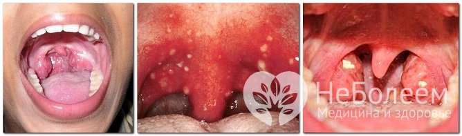 Для постановки диагноза проводится фарингоскопия, при необходимости врач делает фото горла