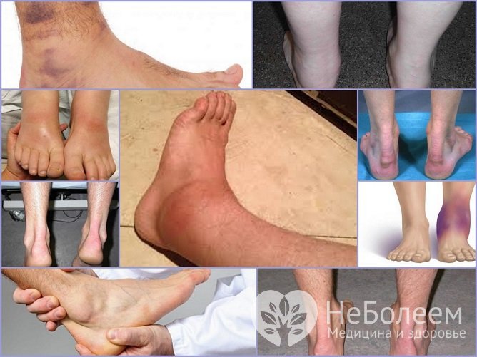 Отечность голеностопного сустава чаще всего вызвана травмой или воспалением суставных тканей