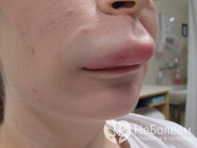 Отек Квинке: причины, симптомы, лечение