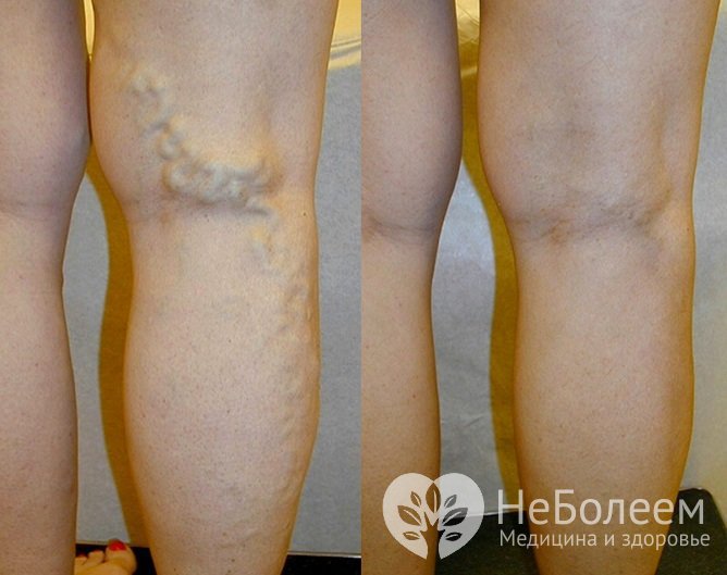 Состояние ног до и после лазерного лечения варикоза