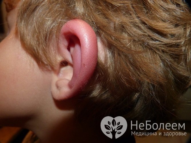 Причиной отека наружного уха чаще всего является травма или аллергия