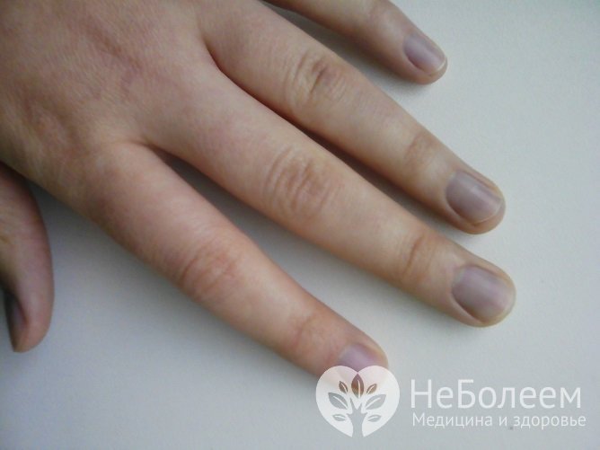 Отек рук, сопровождающийся цианозом (посинением) ногтей при заболеваниях сердца