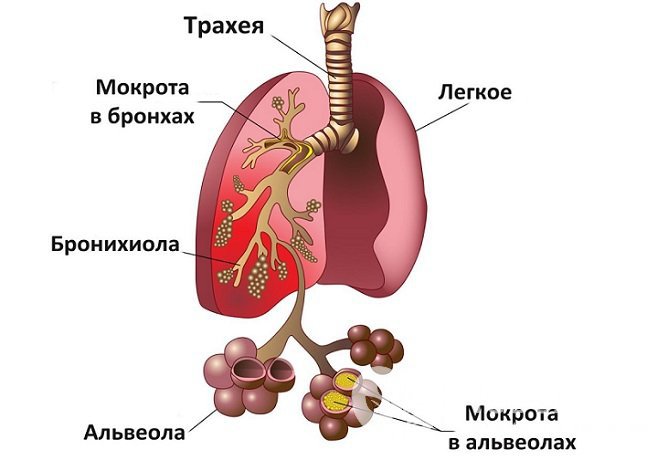 При пневмонии воспалительный процесс может развиваться в разных структурах легкого