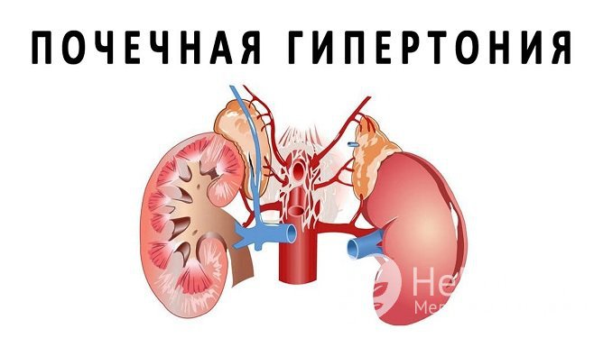 Почечное давление: симптомы, причины, диагностика и лечение