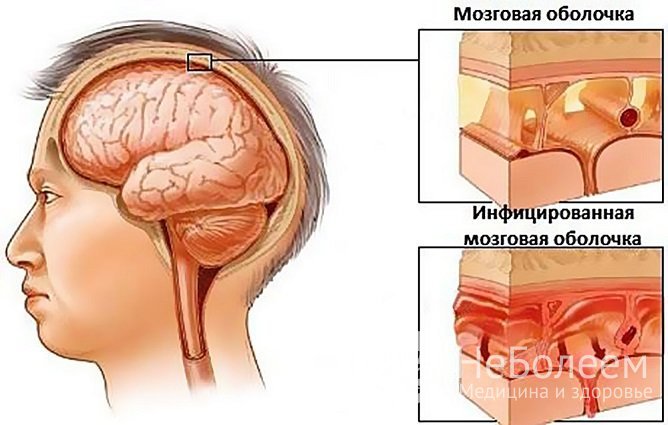 Менингит – одно из самых тяжелых осложнений гайморита