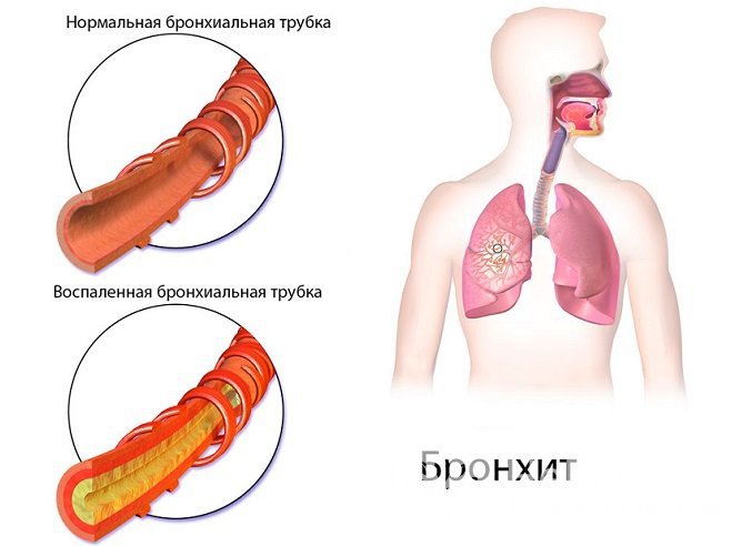 Одно из возможных последствий гайморита – бронхит