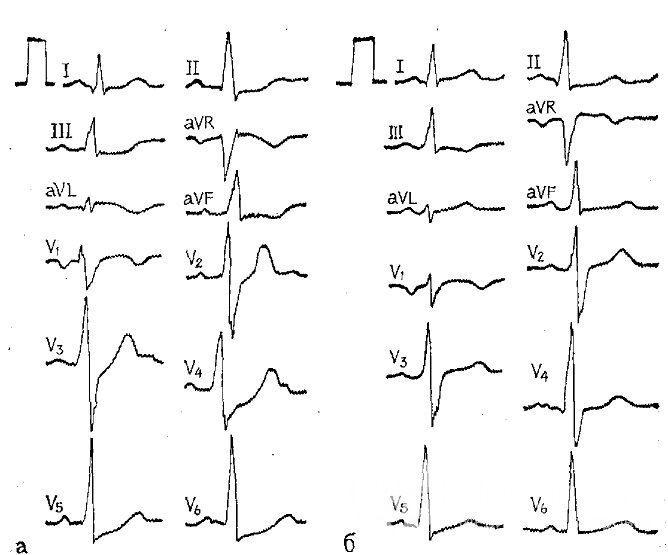 Основной метод диагностики инфаркта – ЭКГ