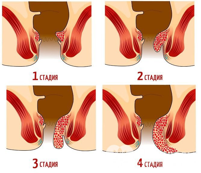 Чем больше стадия геморроя, тем значительнее и чаще кровотечения