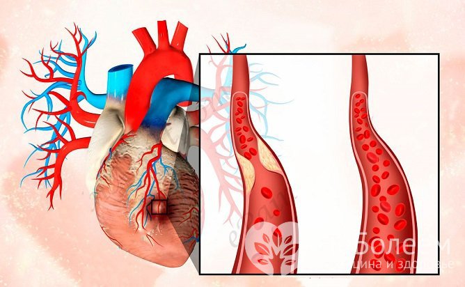 Причиной инфаркта является нарушение кровоснабжения сердечной мышцы
