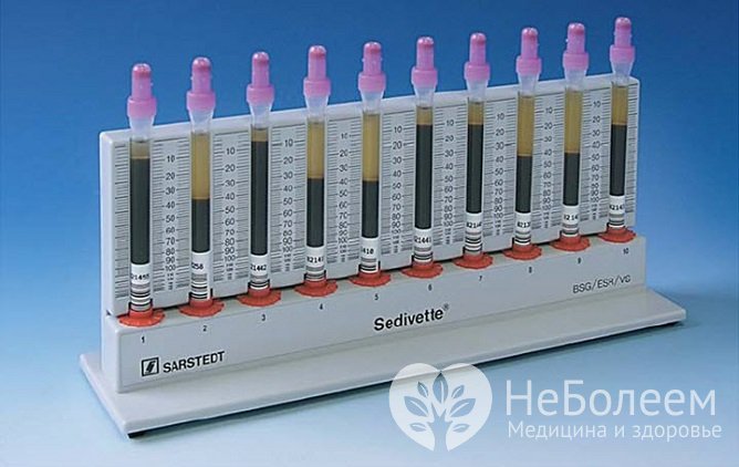 Скорость оседания эритроцитов изменяется на фоне развития разных заболеваний