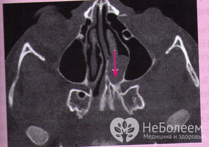 При проведении диагностики ринита у детей грудного возраста нужно исключить частичную атрезию хоан