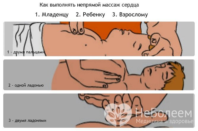 Родители должны уметь выполнять непрямой массаж сердца