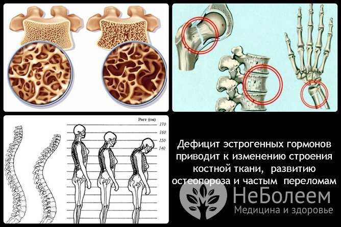 Дефицит эстрогенов приводит к серьезным нарушениям в организме