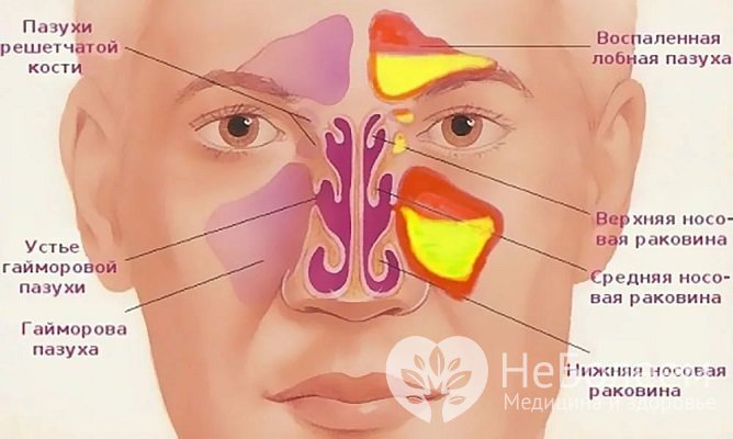 Синусит развивается в результате воспаления слизистой оболочки одной или нескольких придаточных пазух носа