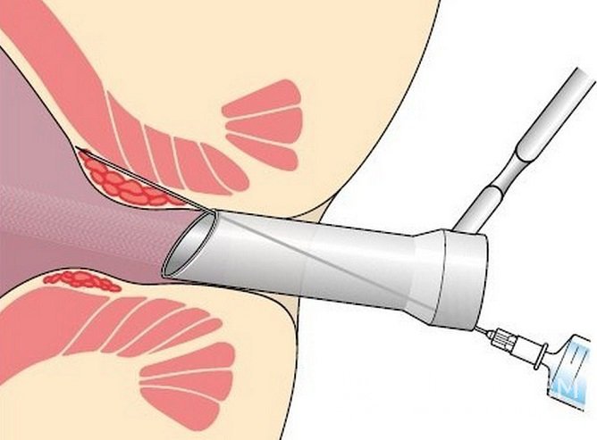 Склеротерапия эффективна при геморрое 1 и 2 стадии