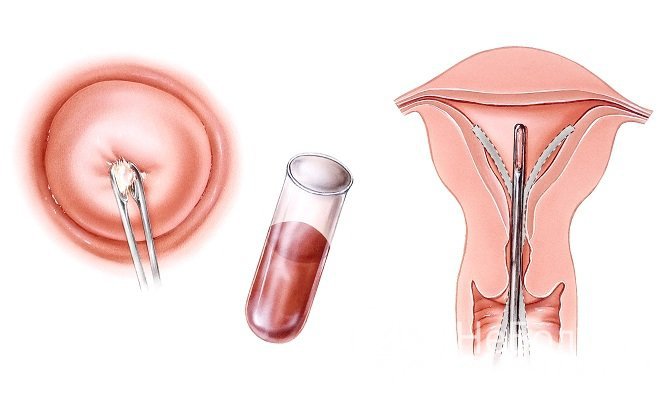 Мазок берут из цервикального канала, в месте перехода плоского эпителия в многослойный