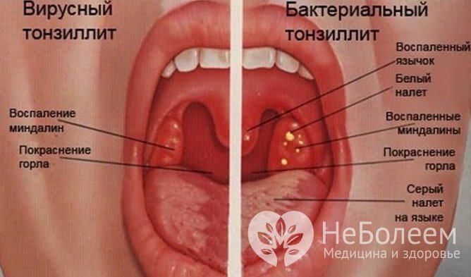 Основные возбудители болезни у детей – вирусы и бактерии