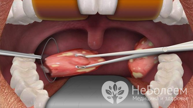 Традиционно операцию проводят при помощи скальпеля и тонзиллэктома