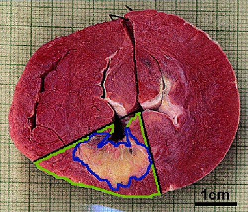 На макропрепарате видна пораженная область некроза, распространяющаяся на всю толщу сердечной мышцы