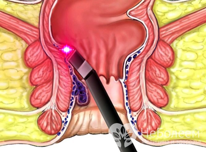 Лазерное удаление геморроя имеет преимуществом отсутствие кровотечения