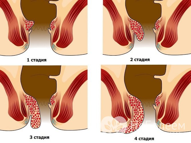 В развитии геморроя выделяют четыре стадии, на последней показано хирургическое лечение