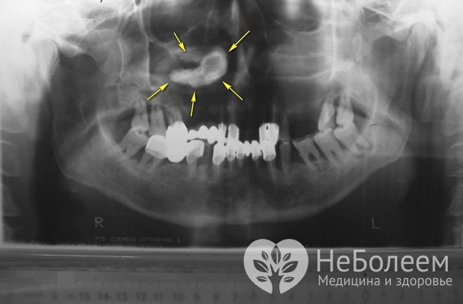 Для диагностики может быть назначена рентгенография для выявления в пазухах инородных тел, опухолей и т. д.