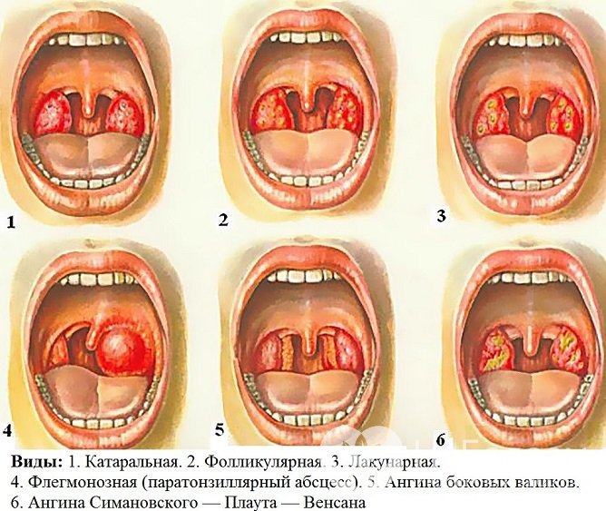 Симптомы ангины зависят от ее формы