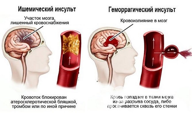 Разные виды инсульта требуют разного подхода к терапии