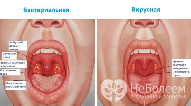 Вирусная ангина: лечение у взрослых, симптомы, осложнения