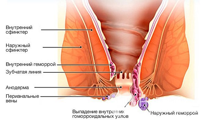 Выпадение геморроидальных узлов начинается со второй стадии геморроя