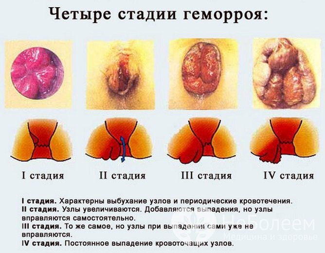 Выпадение узлов служит диагностическим признаком для определения стадии геморроя