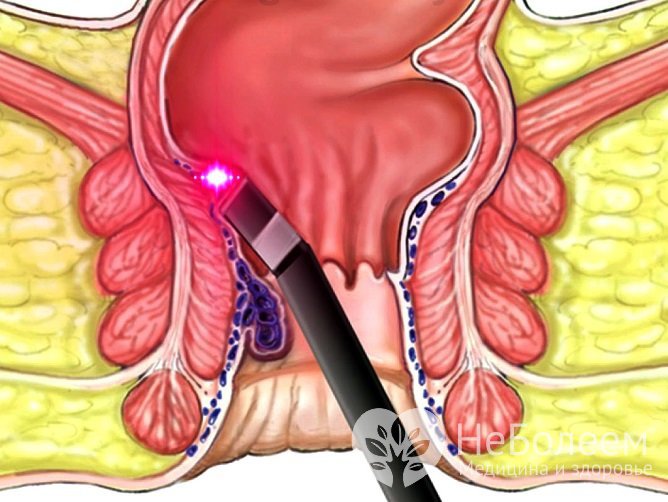 Одним из эффективных методов удаления геморроидальных узлов является лазерная коагуляция