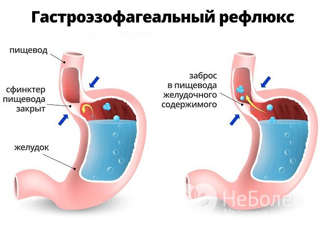 Одна из частых причин кашля, вызванного проблемами ЖКТ – гастроэзофагеальный рефлюкс