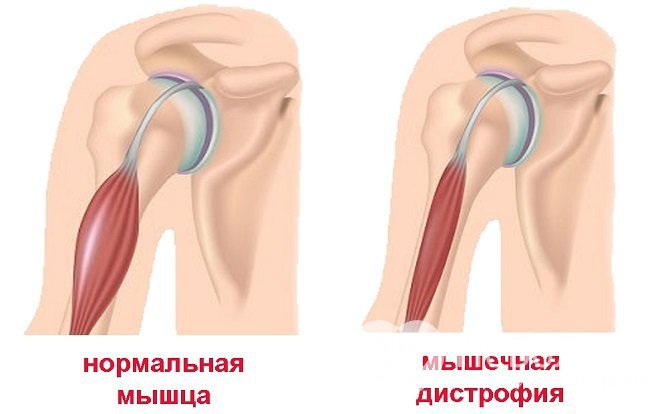 Миопатия характеризуется мышечной дистрофией, а затем и атрофией